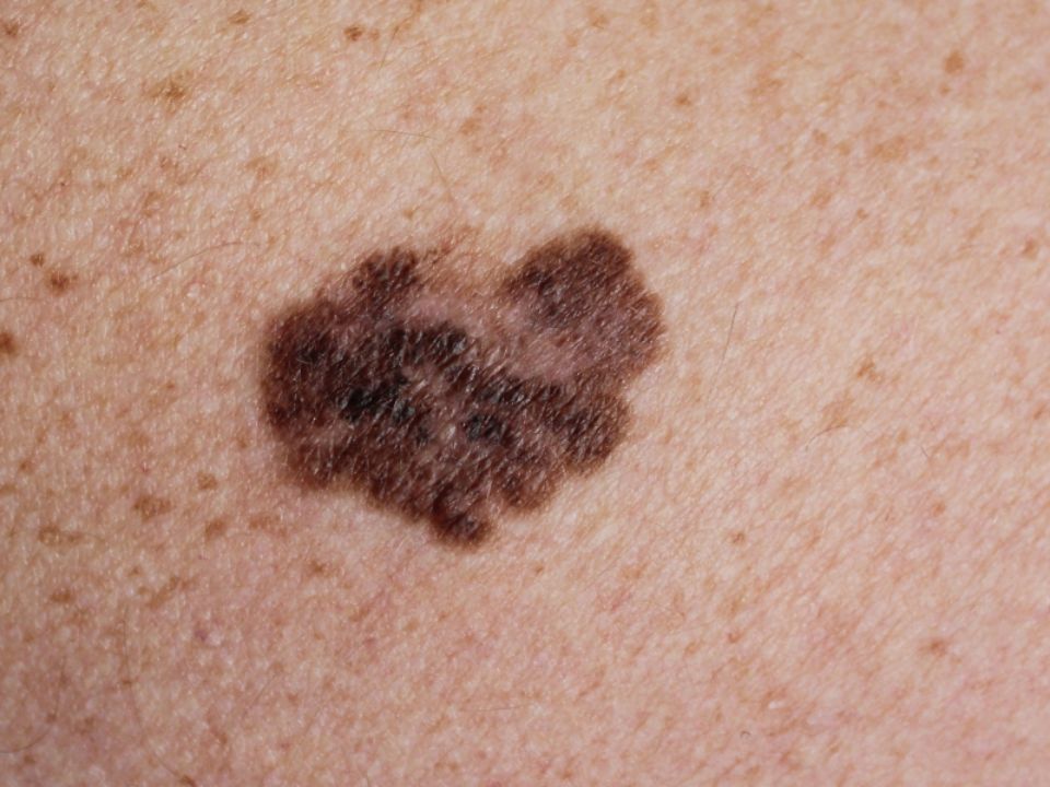 Cancer de la peau: savoir l'identifier et réagir
